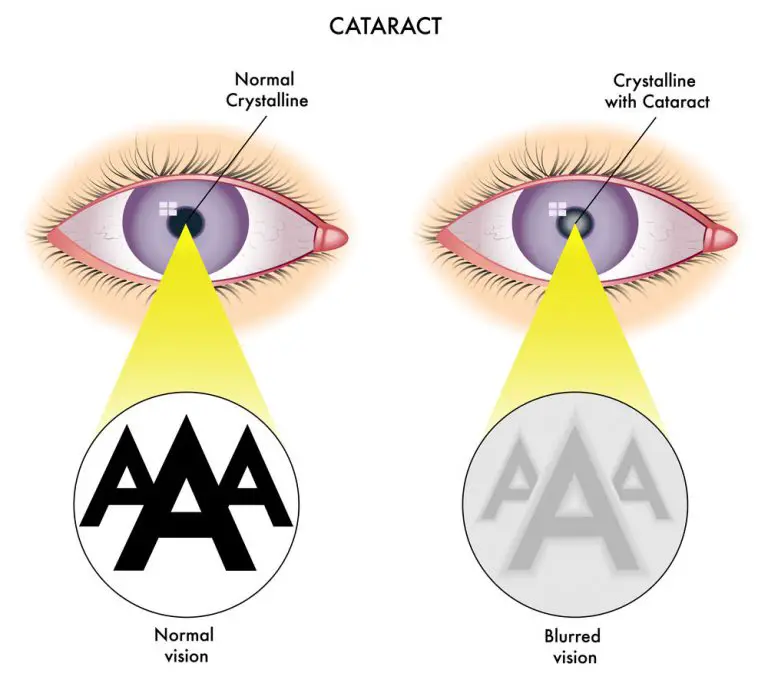 Cataract Surgery: Do You Need Vision Coverage?