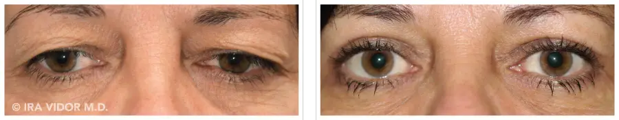 Does Insurance Cover Blepharoplasty or other Eyelid Surgery?