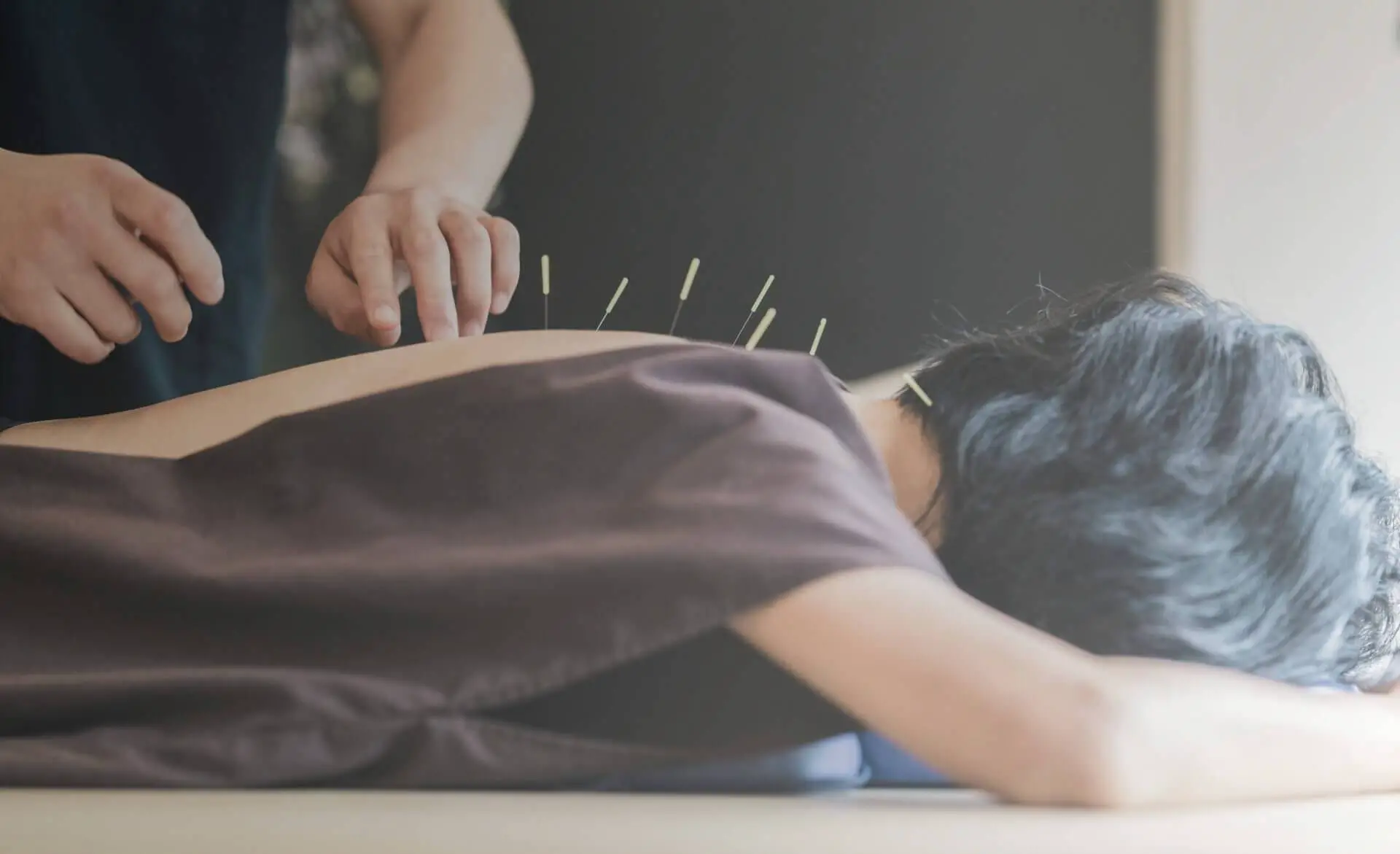 Does Medicare Cover Acupuncture?