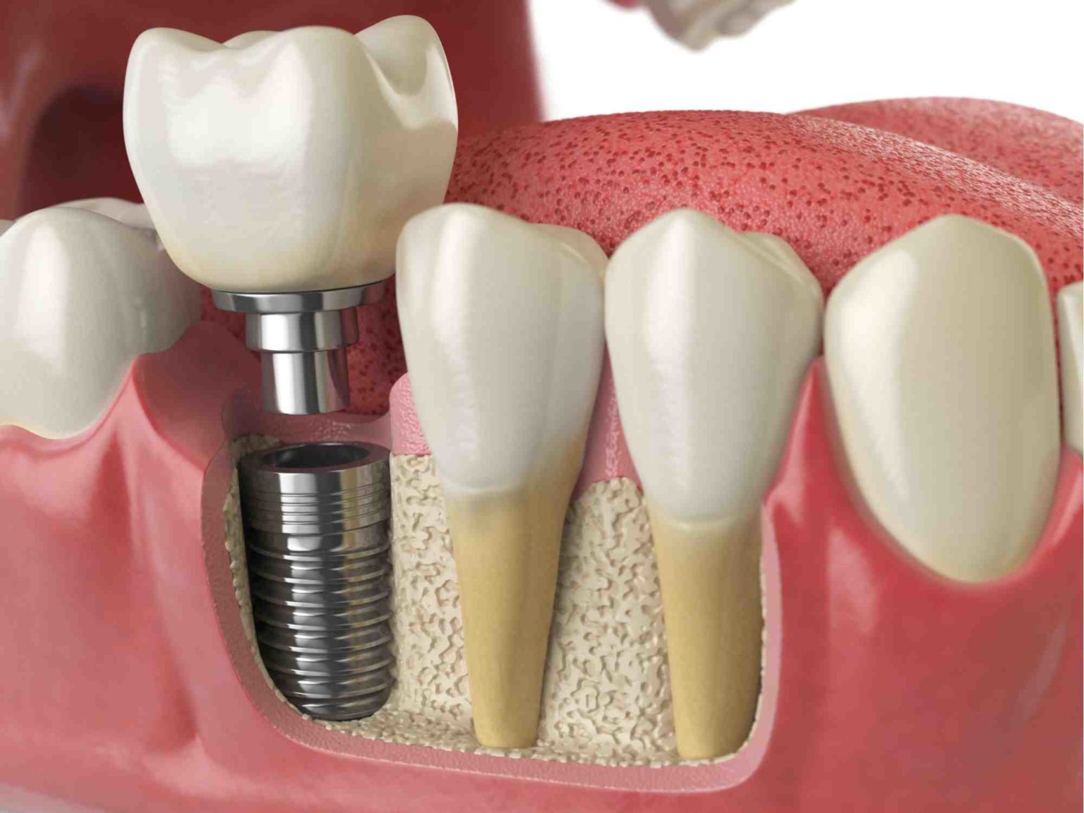 Does medicare cover dental implants