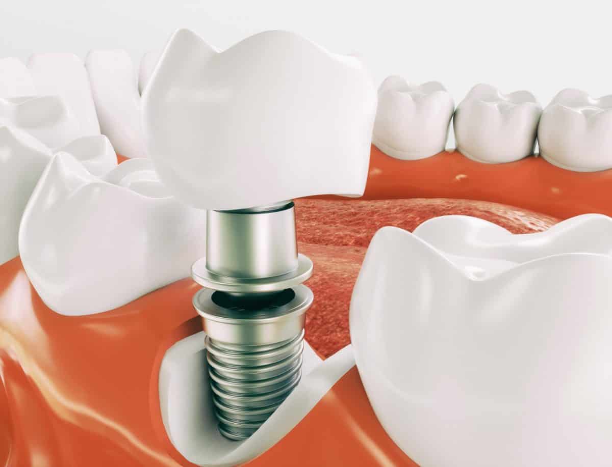 Does Medicare Cover Dental Implants?