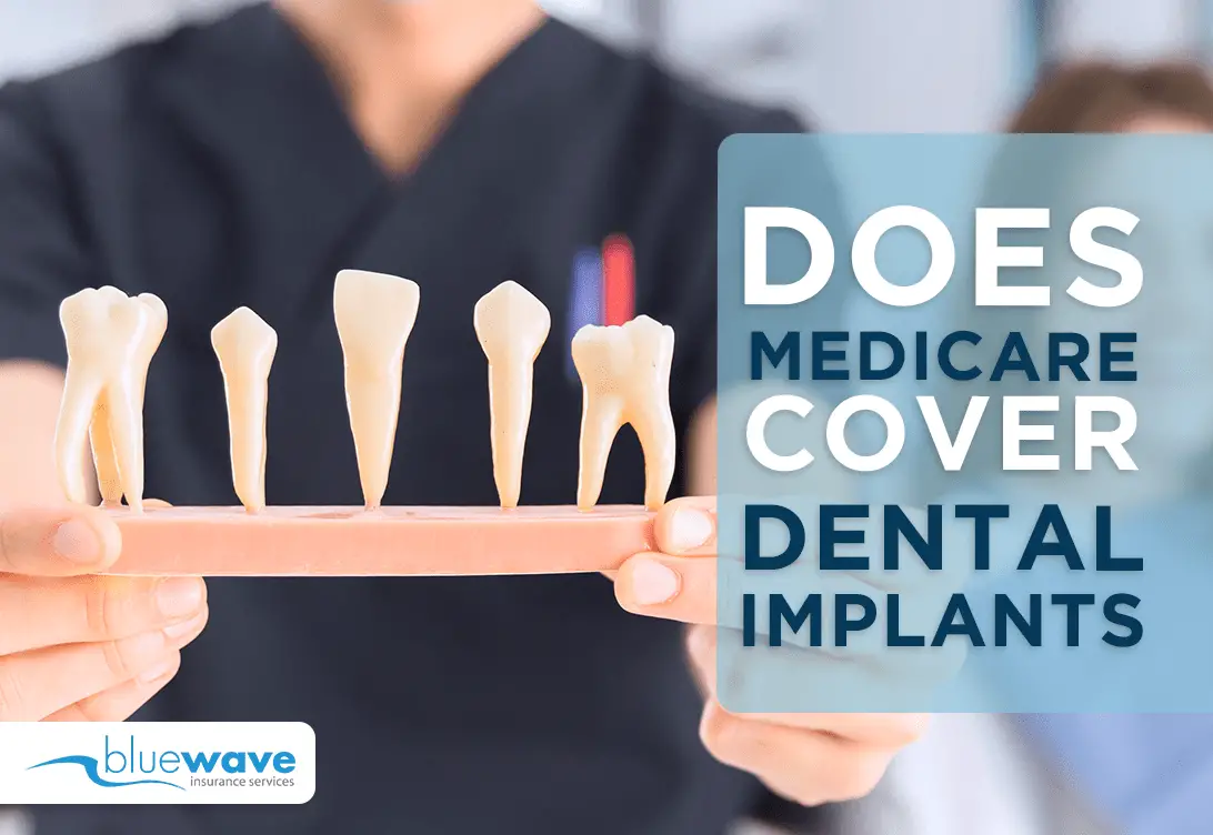 Does Medicare Cover Dental Implants? What You Need To Know