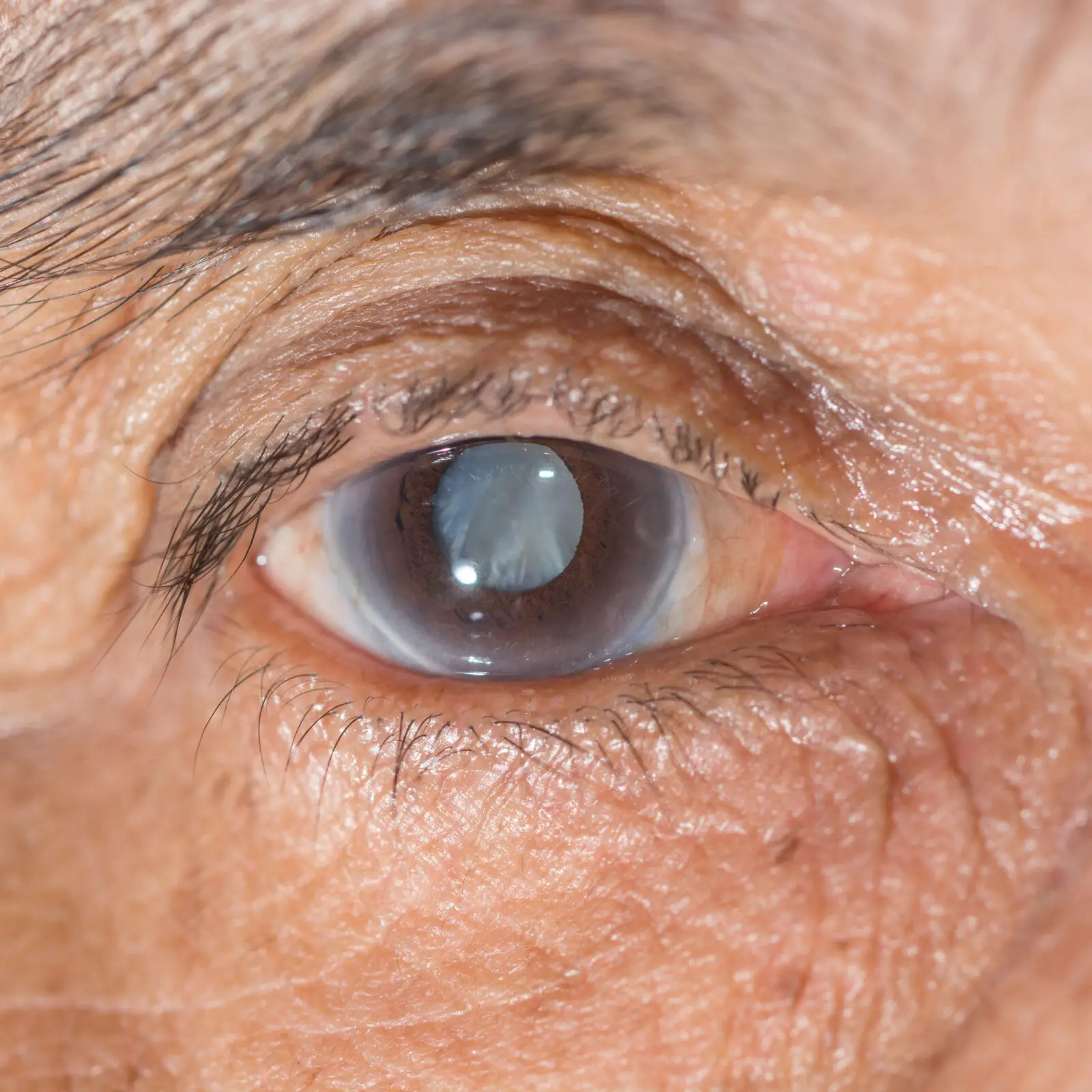 Does Medicare Cover Eye Surgery?