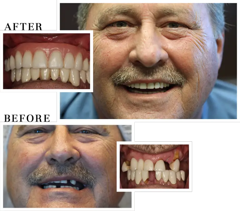 Dr. Manesh  New Teeth in 1 Day*