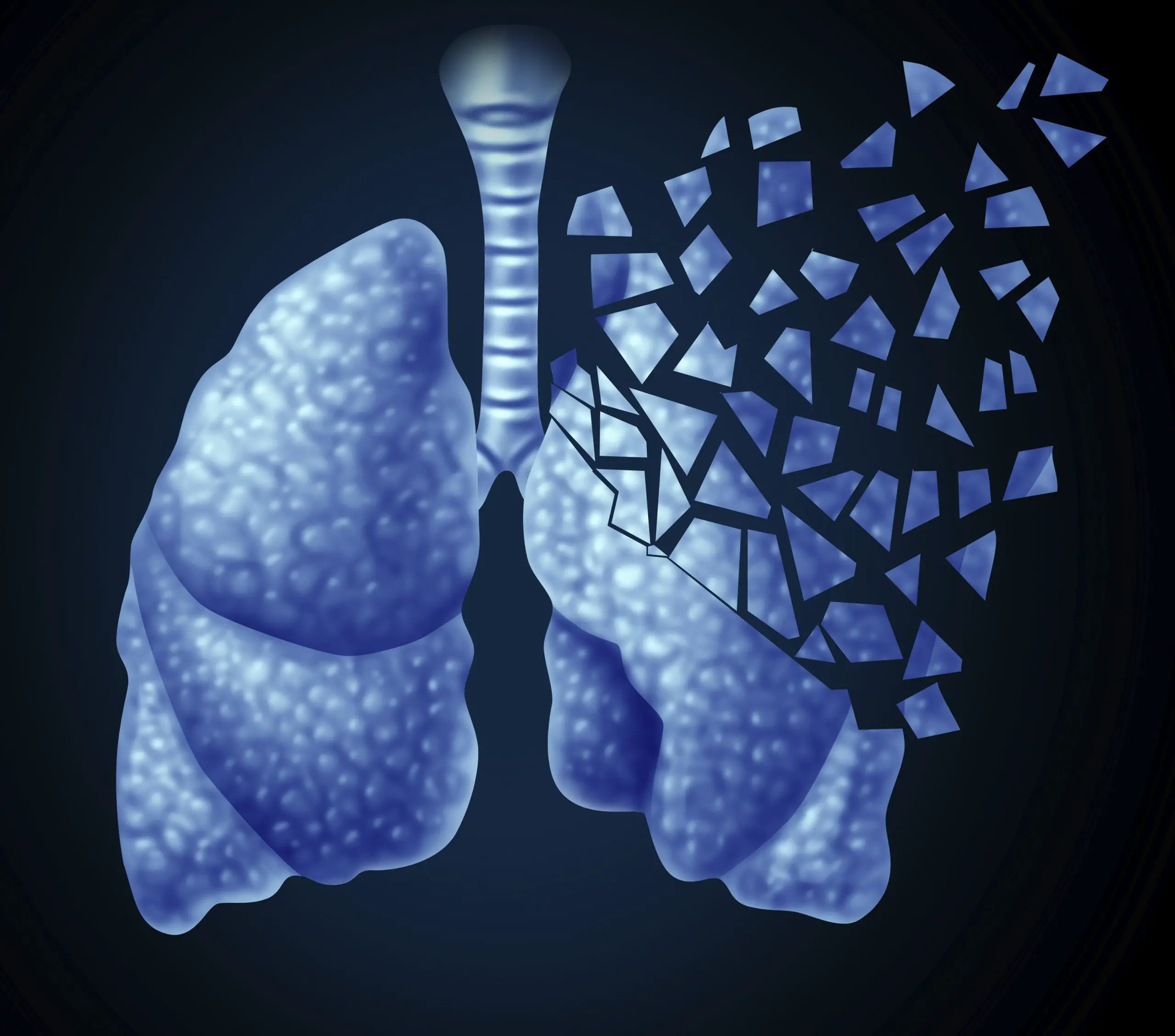 How Common Is Lung Cancer Worldwide?