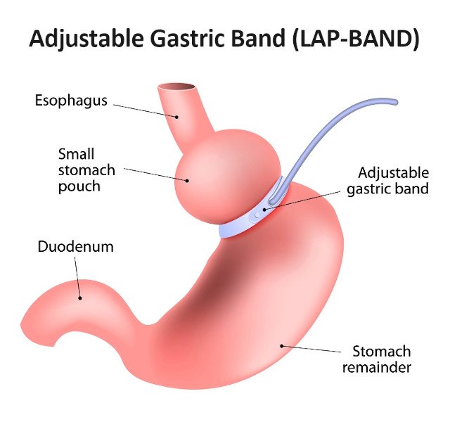 How Much Is Lap Band Surgery Without Insurance