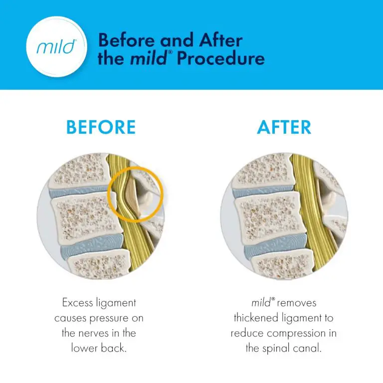 Learn More About the mild® Procedure Available at South Central Pain ...
