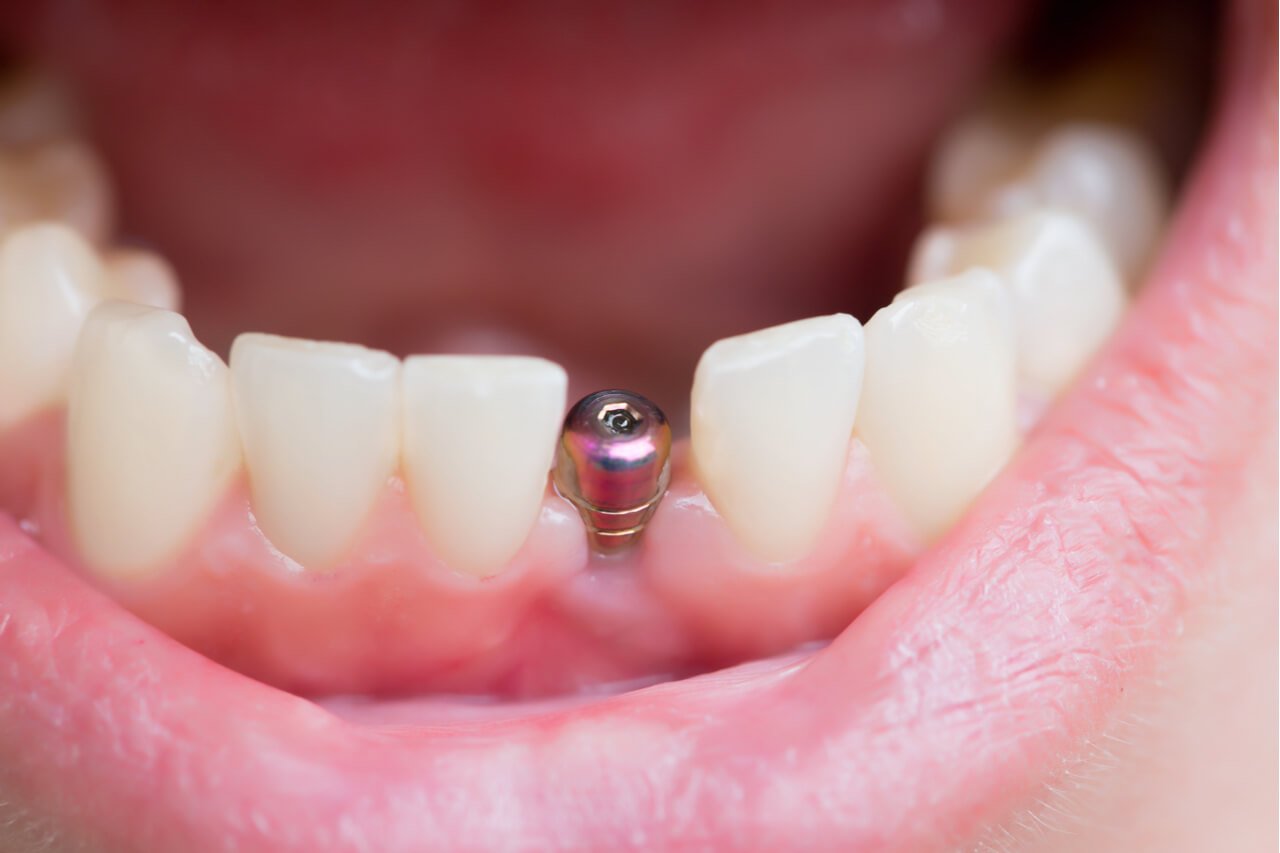 Medicare and dental implants: Can you get coverage?
