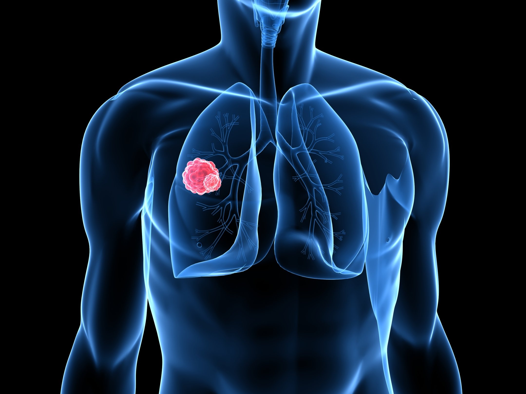 Medicare coverage of lung cancer screening explained