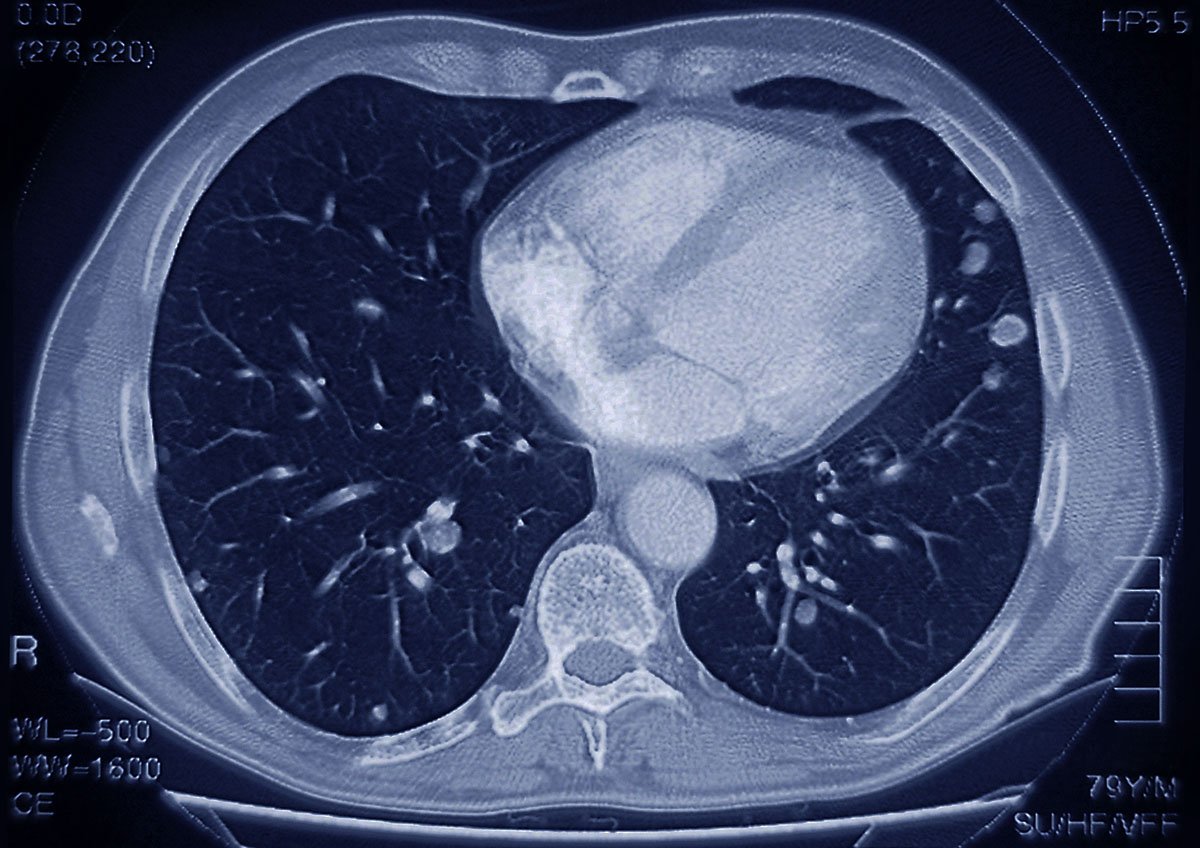 Medicare will pay for lung CT scans for cancer screening