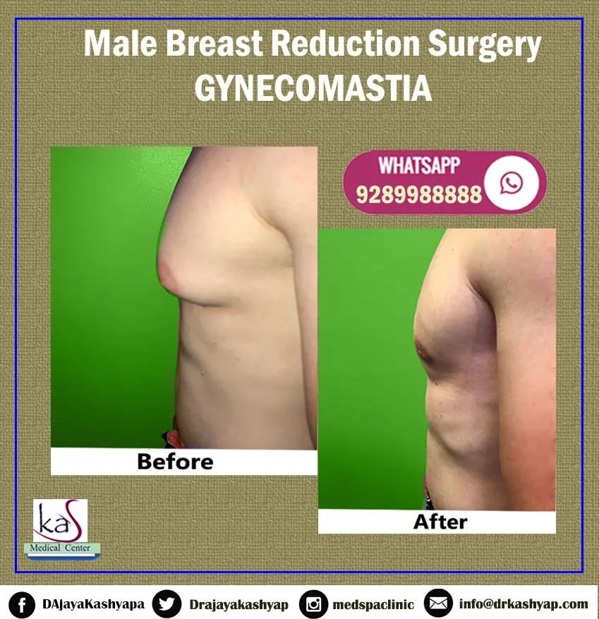 Pin on Gynecomastia Treatment Before After Image