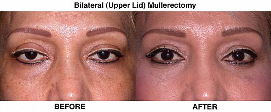 Upper Eyelid Blepharoplasty/Ptosis REpair