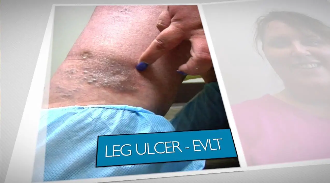 Vein Treatment Chicago: Does Medicare Cover Leg Ulcers?