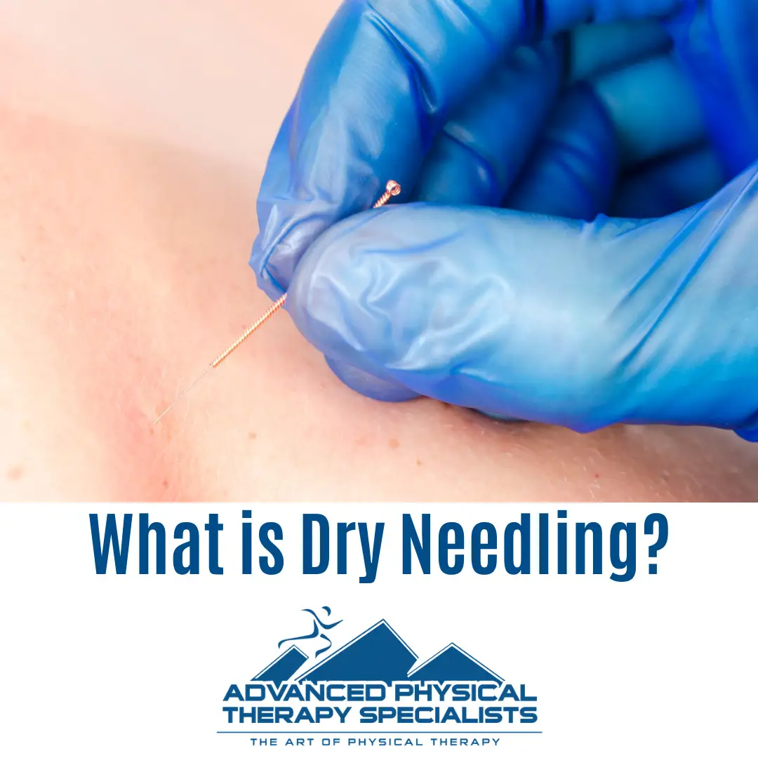What is Dry Needling?