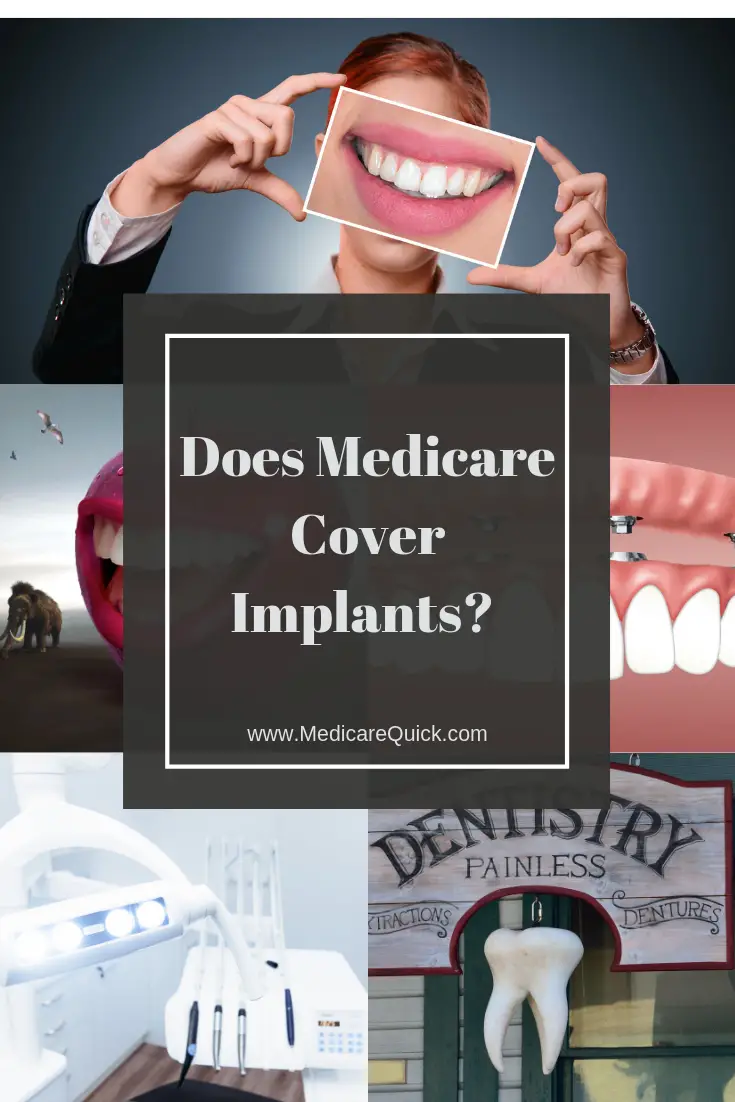 What Medical Insurance Covers Dental Implants